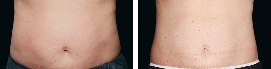 Coolsculpting Vorher Nachher Foto