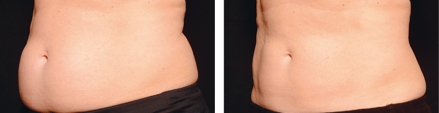 Coolsculpting Vorher Nachher Foto