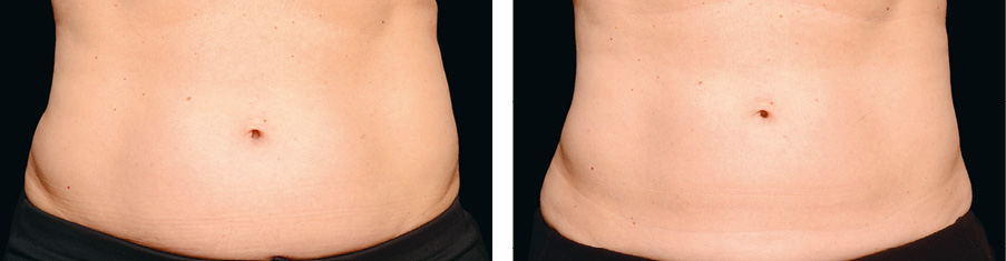 Coolsculpting Vorher Nachher Foto