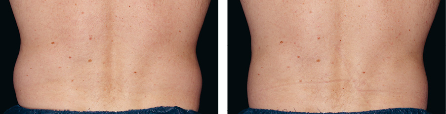 Coolsculpting Vorher Nachher Foto