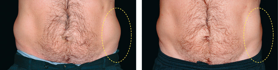 Coolsculpting Vorher Nachher Foto