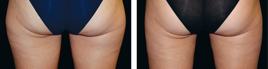 Coolsculpting Vorher Nachher Foto