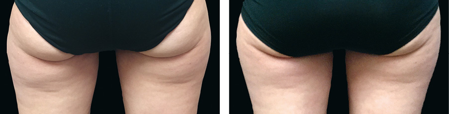 Coolsculpting Vorher Nachher Foto