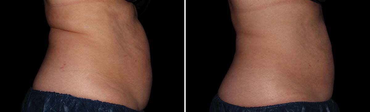 Coolsculpting Vorher Nachher Foto