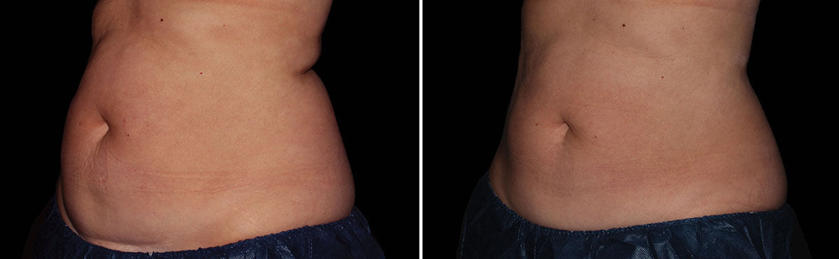 Coolsculpting Vorher Nachher Foto