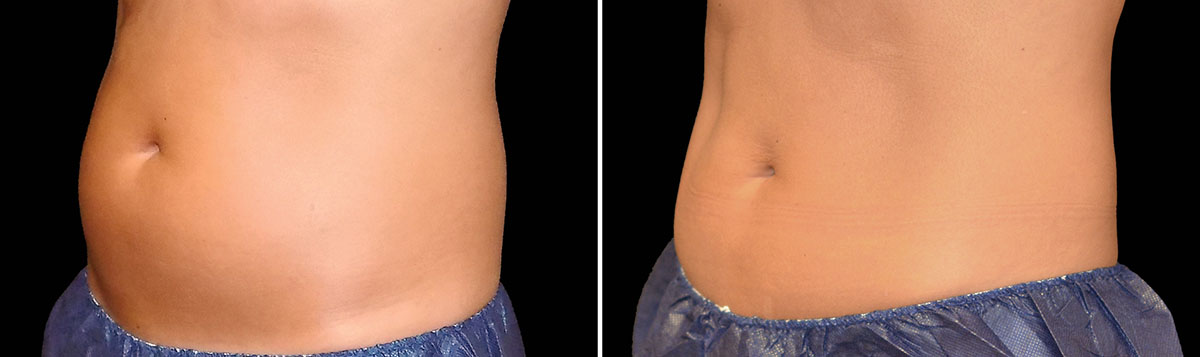 Coolsculpting Vorher Nachher Foto