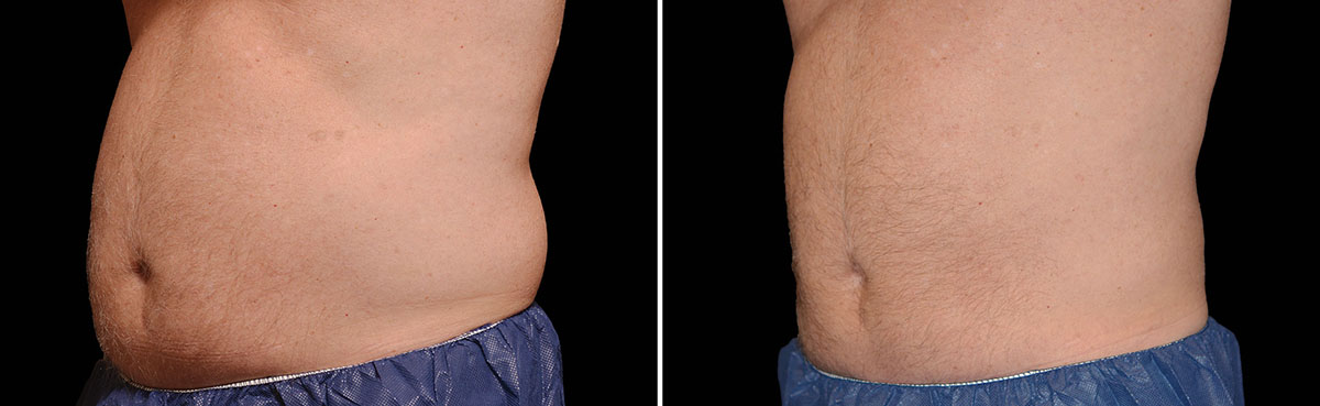 Coolsculpting Vorher Nachher Foto