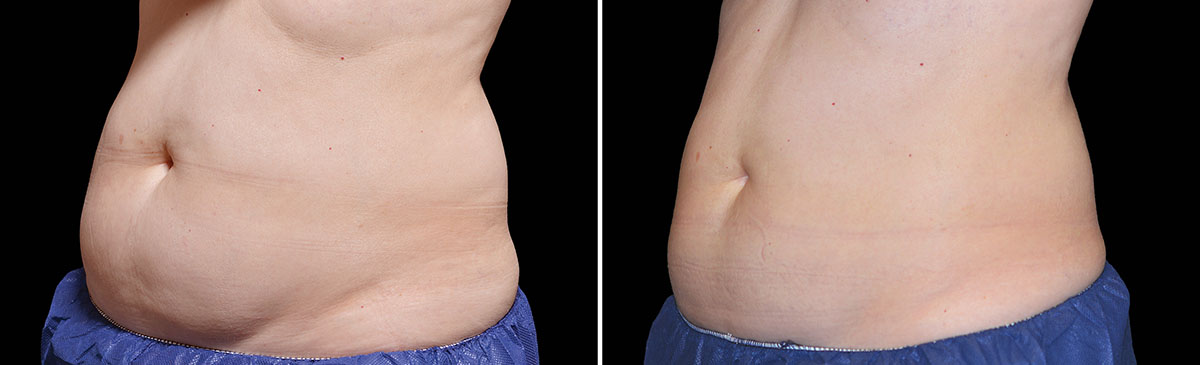 Coolsculpting Vorher Nachher Foto