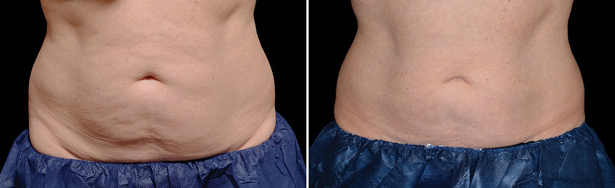 Coolsculpting Vorher Nachher Foto