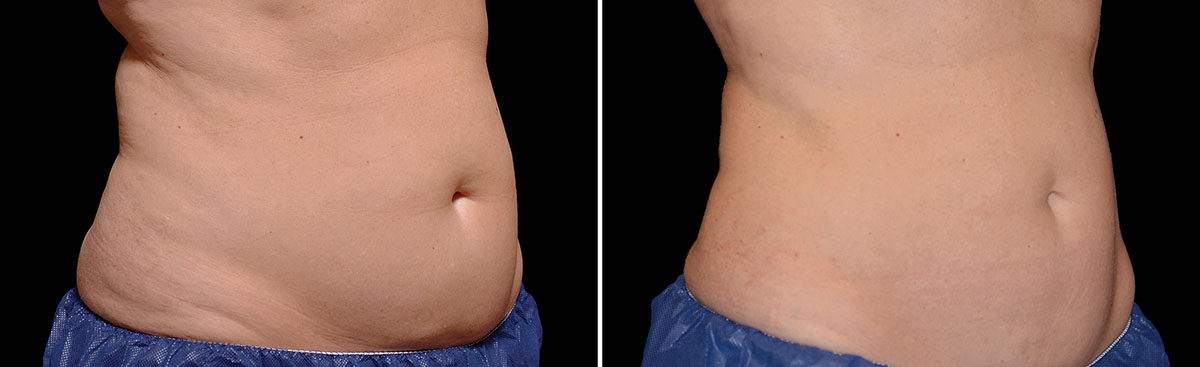 Coolsculpting Vorher Nachher Foto