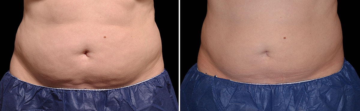 Coolsculpting Vorher Nachher Foto