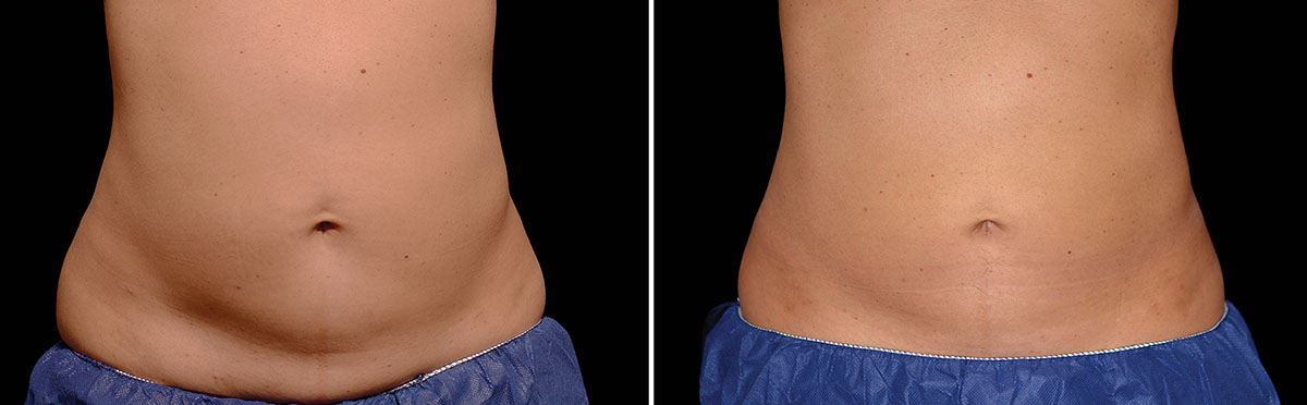 Coolsculpting Vorher Nachher Foto