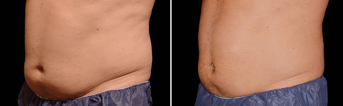 Coolsculpting Vorher Nachher Foto