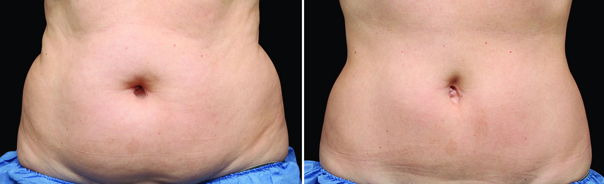 Coolsculpting Vorher Nachher Foto