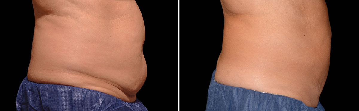 Coolsculpting Vorher Nachher Foto