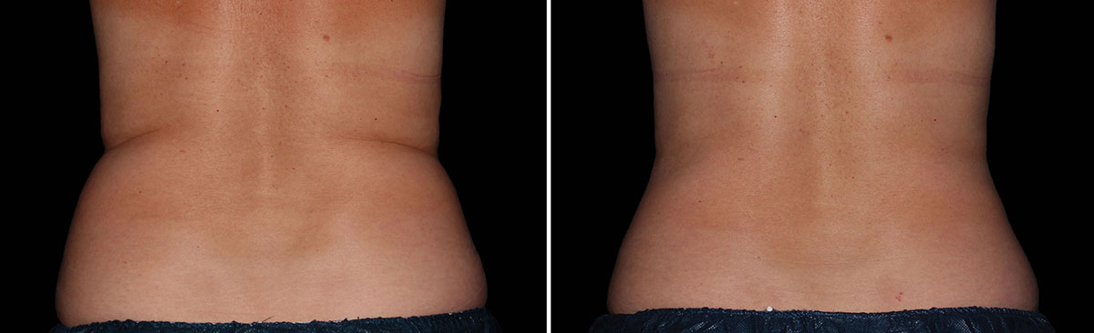 Coolsculpting Vorher Nachher Foto