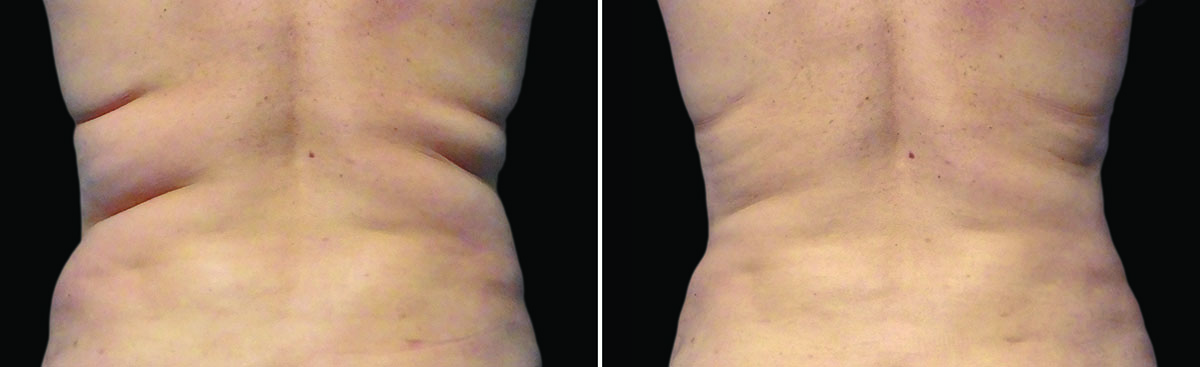 Coolsculpting Vorher Nachher Foto