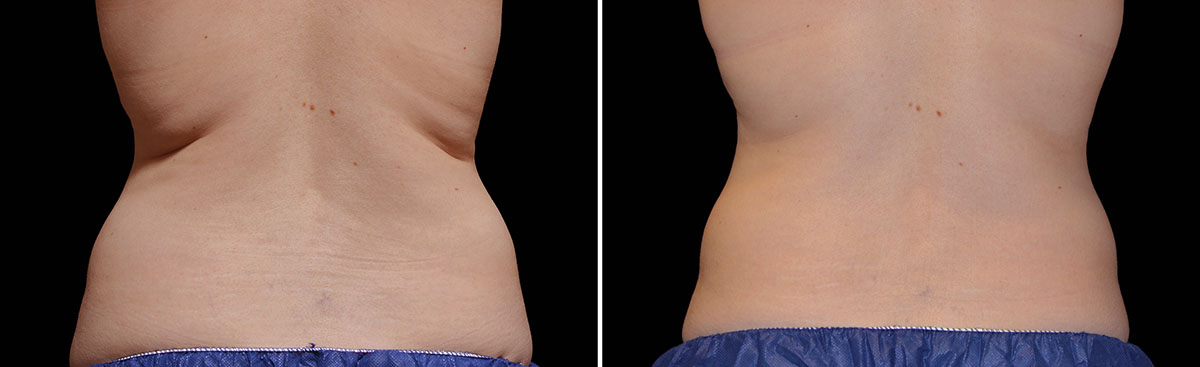 Coolsculpting Vorher Nachher Foto