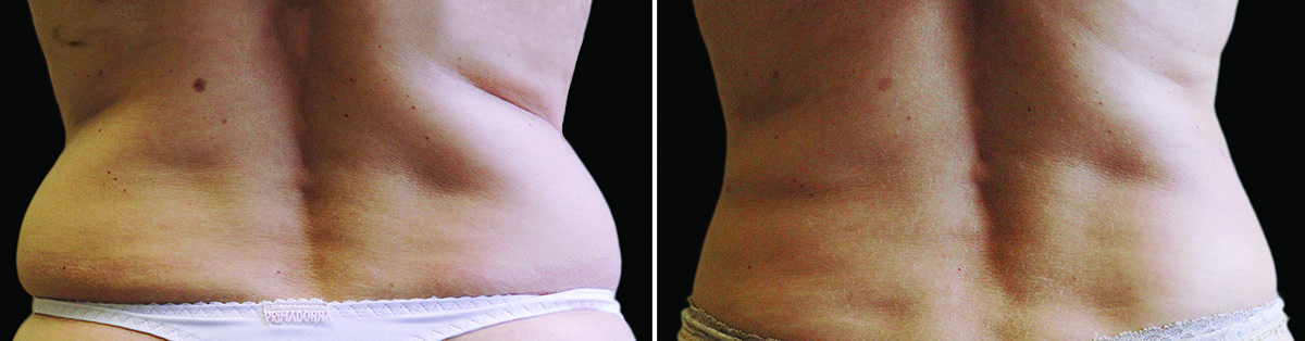 Coolsculpting Vorher Nachher Foto