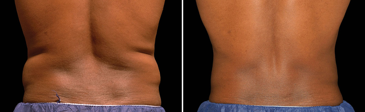 Coolsculpting Vorher Nachher Foto